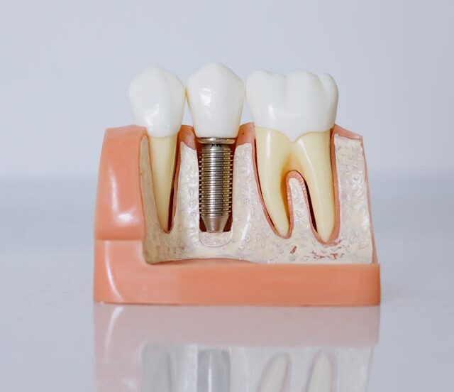 dental implant